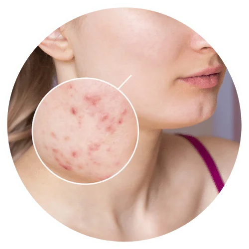 Acne and Pimples Treatment Ambala