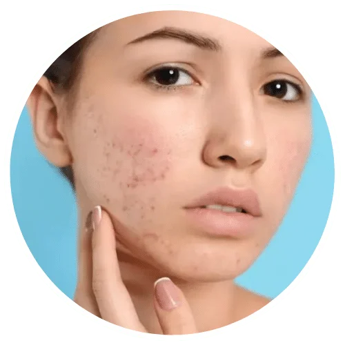 Acne and Pimples Treatment