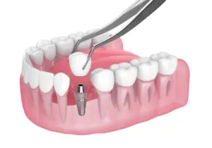 Dental implant 1