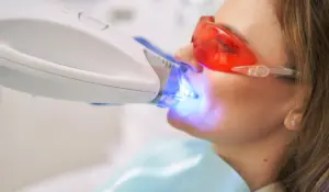 Laser dental whitening