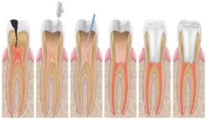 Root canal treatment 1