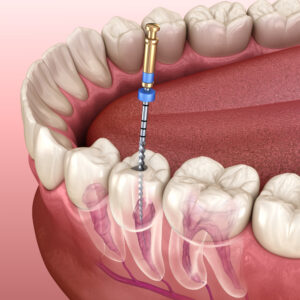 Root canal treatment 2