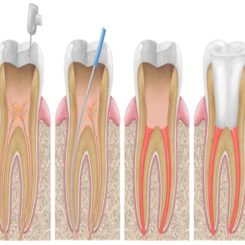 Root canal treatment 1
